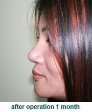 plastic_surgery_augmentation_rhinoplasty